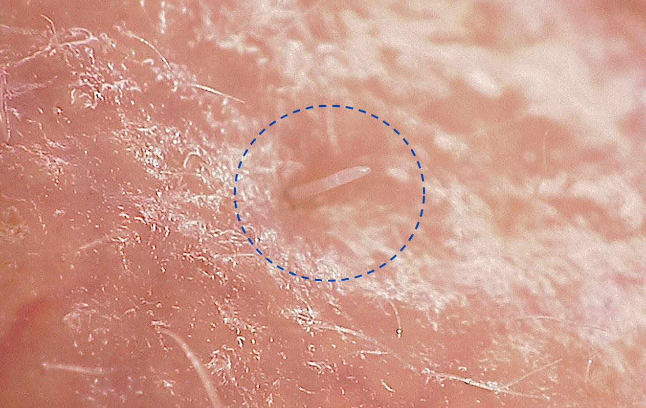 Illustration of the skin layers where Demodex mites reside