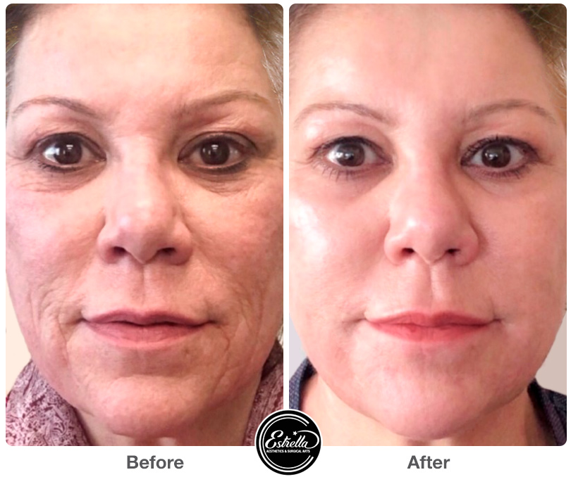 Scarlet SRF radiofrequency microneedling before and after skin tightening results