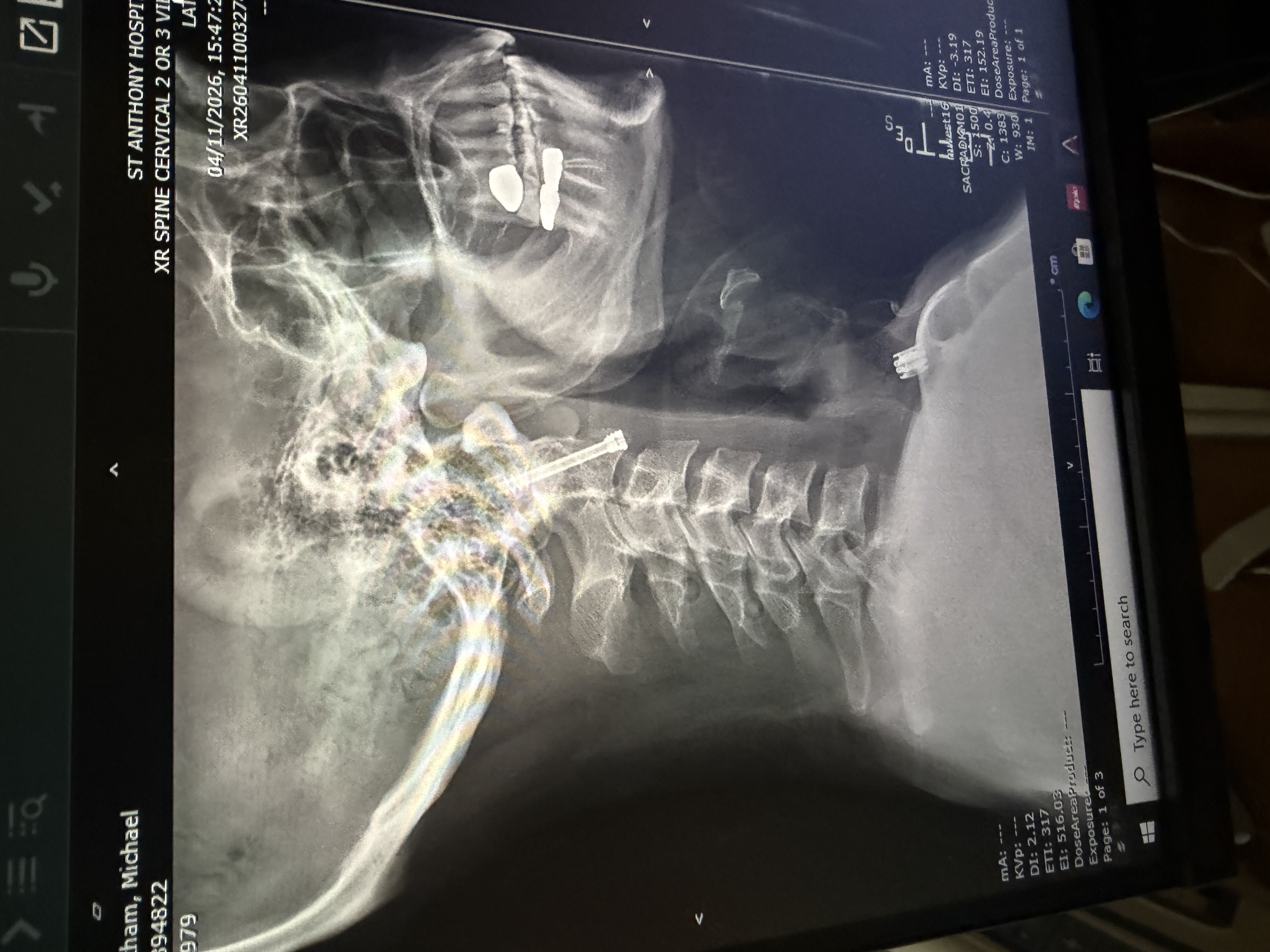 Actual Scan of Fused C2 Vertebrae Post Surgery